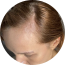 Thinning hair at the part