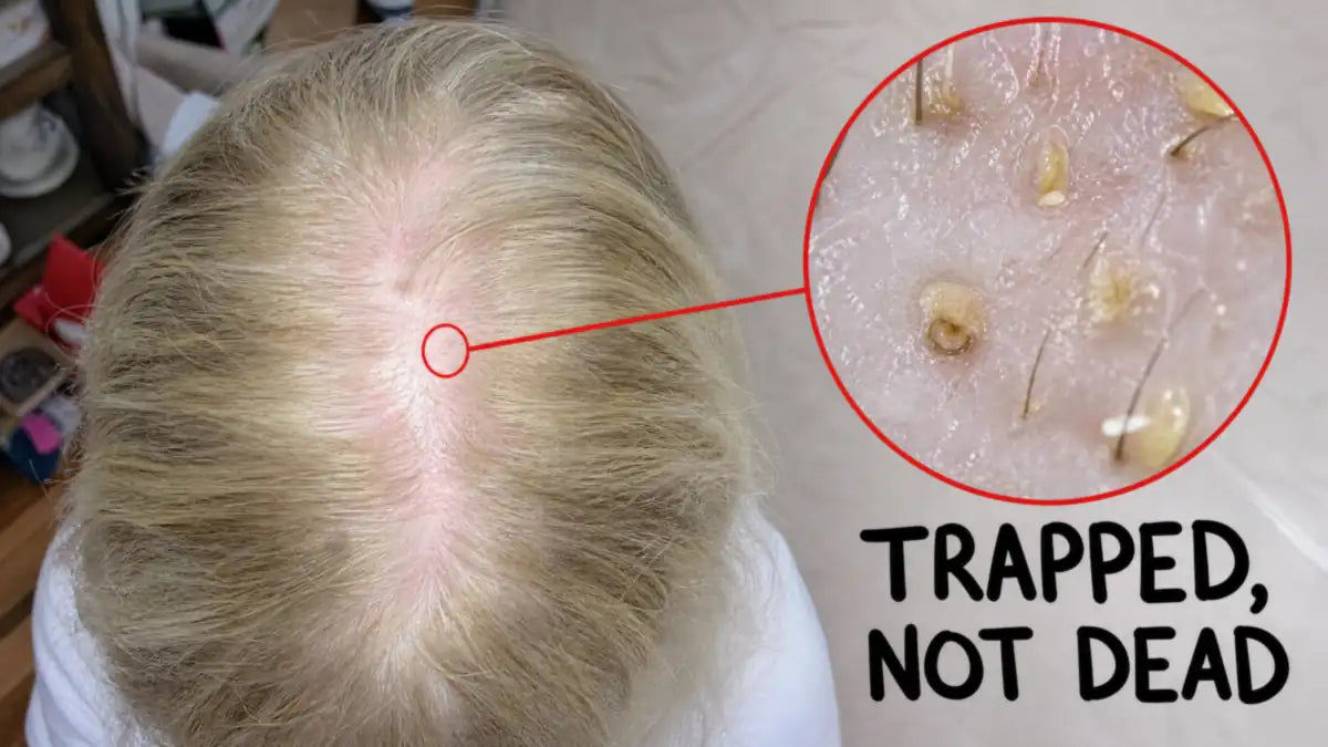 Close-up of a thinning scalp with a magnified view of clogged follicles — trapped, not dead